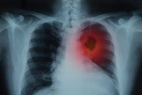Tipos de câncer de pulmão