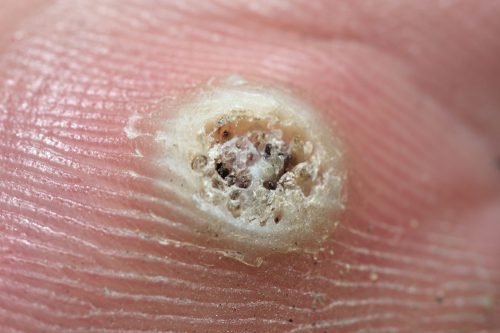 Verrugas podem ser sinal de Vírus do Papiloma Humano