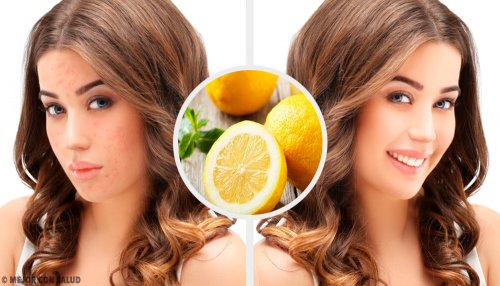 4 remédios naturais para eliminar cicatrizes de acne na cara