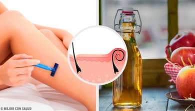 5 remédios naturais para tratar a pseudofoliculite