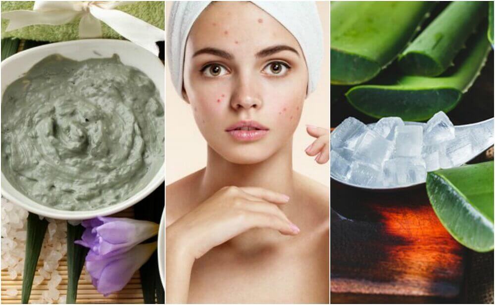 5 tratamentos de origem natural para a acne no rosto