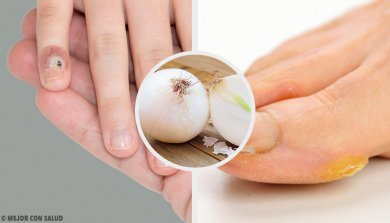 Como eliminar os calos das mãos e dos pés de forma natural