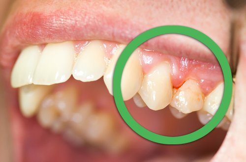 Tratamento natural para gengivite