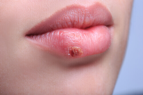 Herpes labial