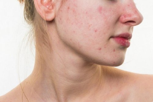 Mulher com acne no rosto