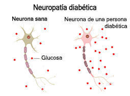 Neropatia diabética