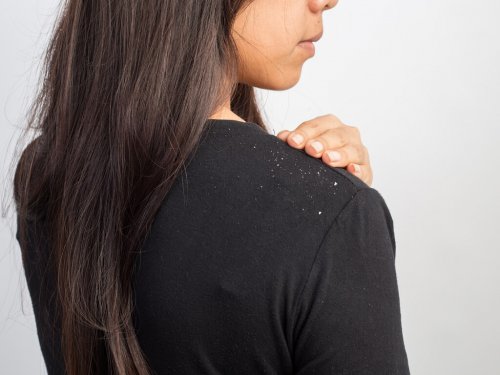 Existem xampus caseiros para tratar a caspa