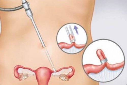 Anticoncepcionais permanentes