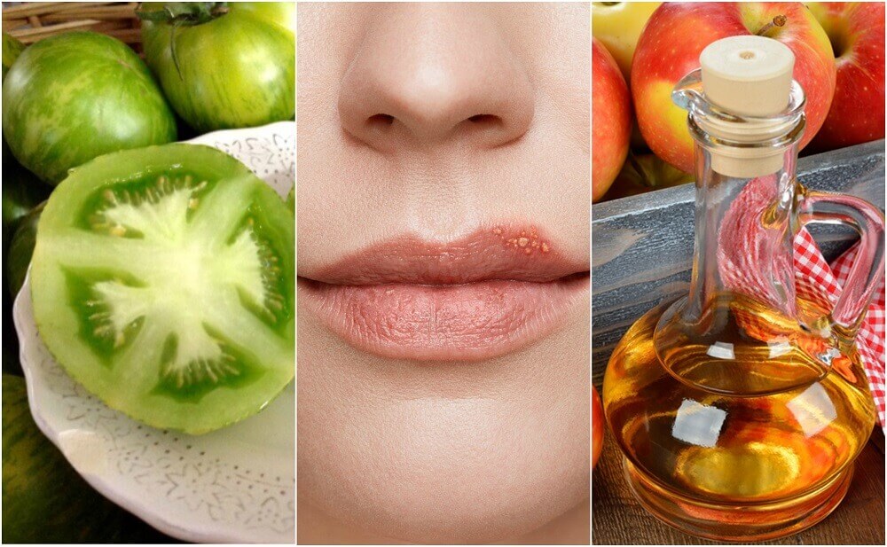 Como combater o herpes labial com 5 tratamentos naturais Como combater o herpes labial com 5 tratamentos naturais