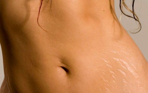 Óleo de argan ajuda a prevenir as estrias