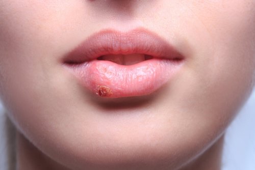 Herpes labial