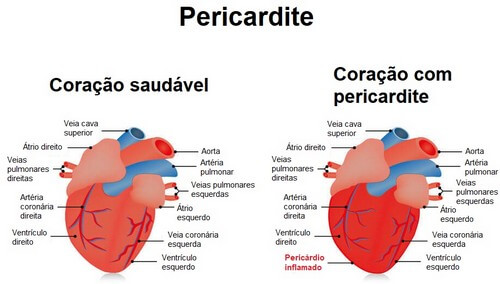 A pericardite é uma doença provocada pela inflamação do pericárdio