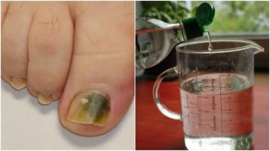Receita à base de álcool e ingredientes naturais para combater os fungos nas unhas