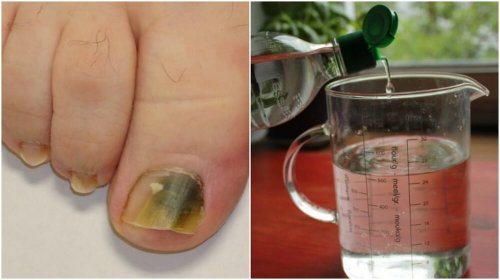 Receita à base de álcool e ingredientes naturais para combater os fungos nas unhas