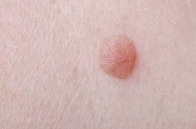 5 tratamentos para se livrar das verrugas planas