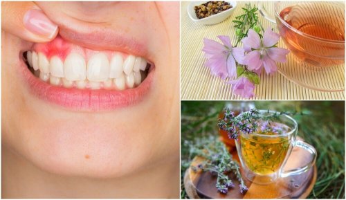 5 soluções naturais para controlar os sintomas da gengivite