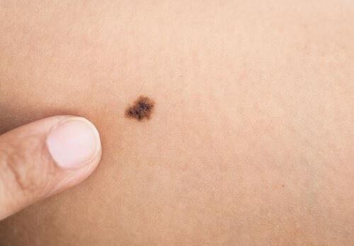 Se surgir pintas, deve levar o bebê ao médico