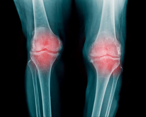 Artrite reumatoide nos joelhos