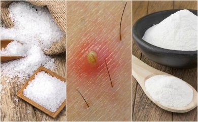 5 soluções naturais para remover os pelos encravados
