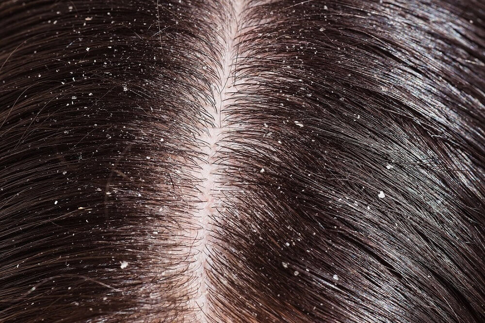 Cabelo com caspa