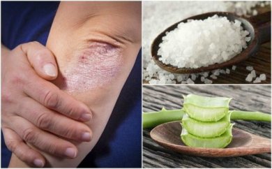 Como combater os fungos na pele com 5 soluções naturais