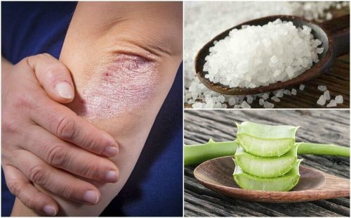 Como combater os fungos na pele com 5 soluções naturais