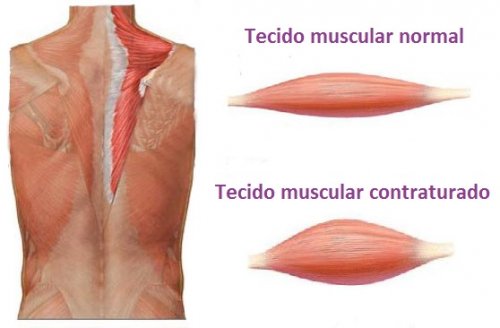 Foto de contratura muscular