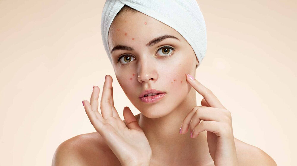 Pele do rosto com acne