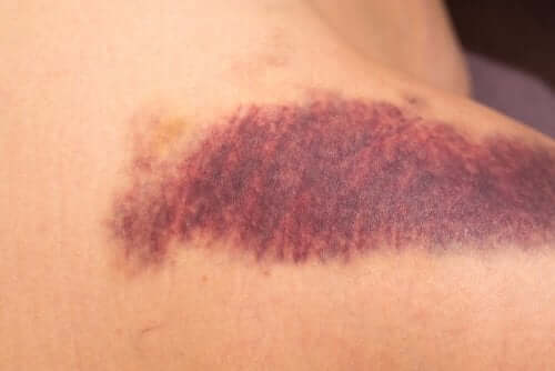 sintomas de que você não consome vitamina K o suficiente