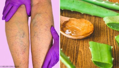 Remédio de aloe vera para as varizes