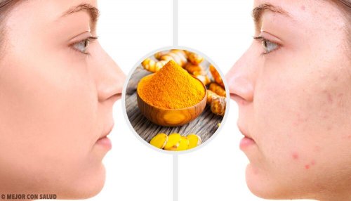 5 máscaras com cúrcuma para eliminar cicatrizes de acne