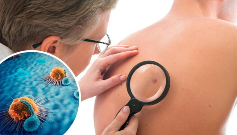 Quais são os sinais de alerta de câncer de pele e como agir?