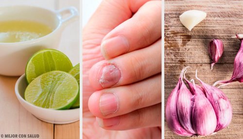 Remédios caseiros para os fungos nas unhas