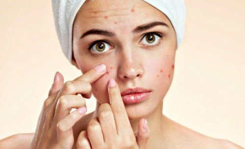 Mulher com acne no rosto