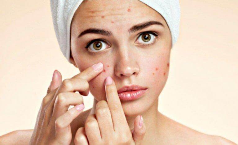 Jovem com acne no rosto