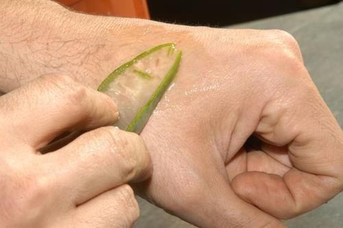 Aloe vera para tratar queimaduras
