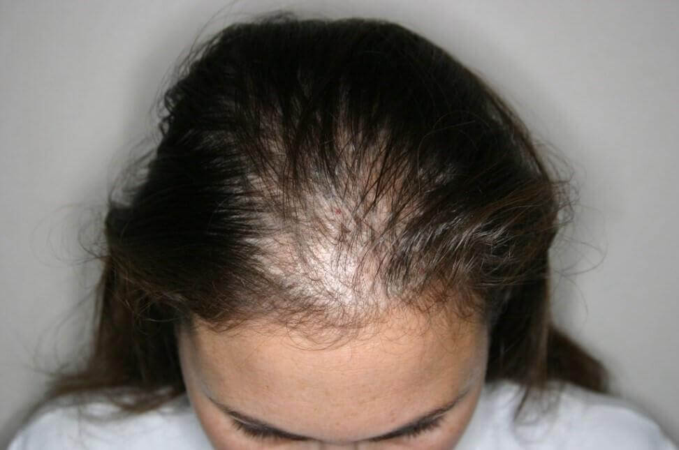 Alopecia areata