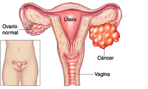 Desenho do câncer de ovário