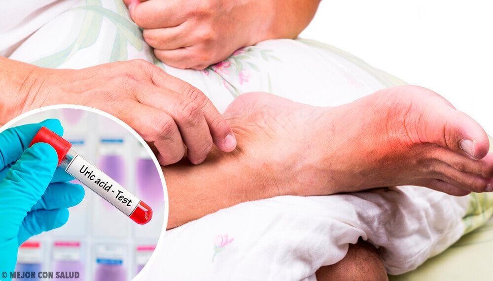 Causas de um nível alto de ácido úrico Causas de um nível alto de ácido úrico