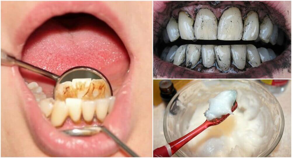 3 tratamentos caseiros para remover o tártaro dos dentes