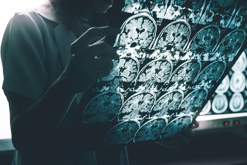 Imagem da doença de Alzheimer