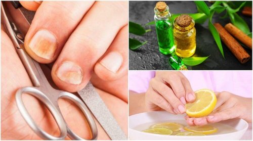 5 truques caseiros e fáceis para eliminar fungos e fortalecer as unhas