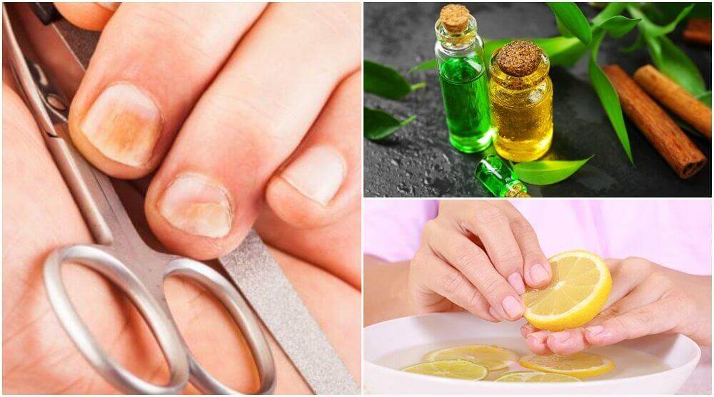 5 truques caseiros e fáceis para eliminar fungos e fortalecer as unhas 5 truques caseiros e fáceis para eliminar fungos e fortalecer as unhas