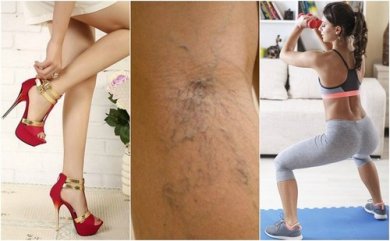 10 dicas para evitar as veias varicosas