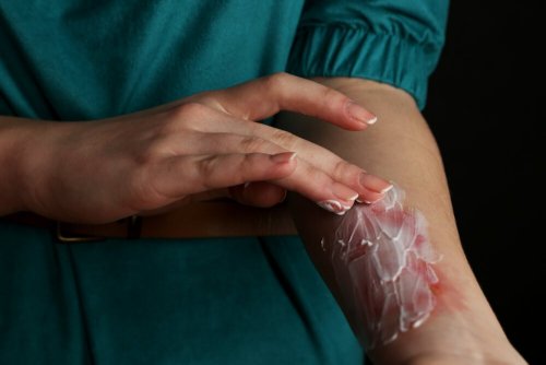 Mulher aplicando creme sobre queimadura
