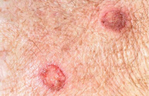 Verrugas são sinais suspeitos