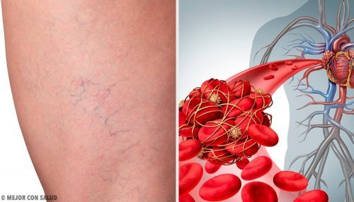Os 3 melhores remédios caseiros para a flebite