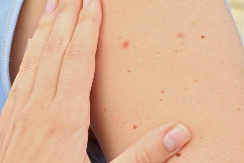 Lunares no braço são sinais suspeitos