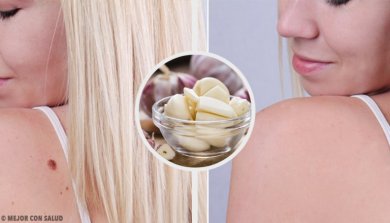 9 formas de acabar com as verrugas rapidamente