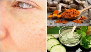 5 remédios naturais para evitar as manchas da idade